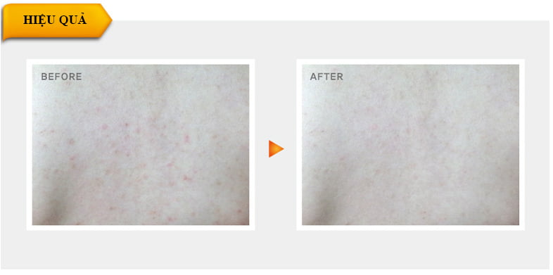 Sữa tắm thảo dược kháng viêm kiểm soát mụn Ac Pure Queenie Mỹ phẩm Hàn Quốc 250ml 15 review sua tam tri mun queenie