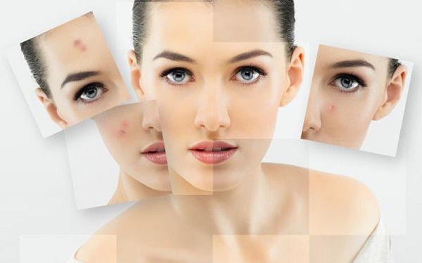 Cách xóa mờ vết thâm sau mụn