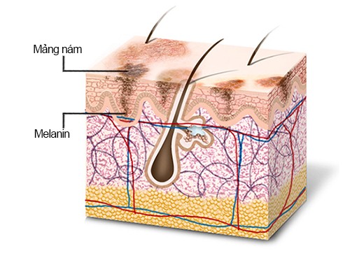 Combo Trị nám Queenie 10 nam 2
