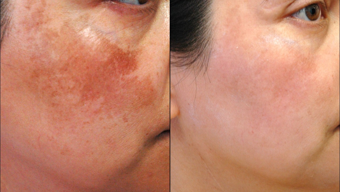 Combo Trị nám Queenie 23 tri nam 2 1
