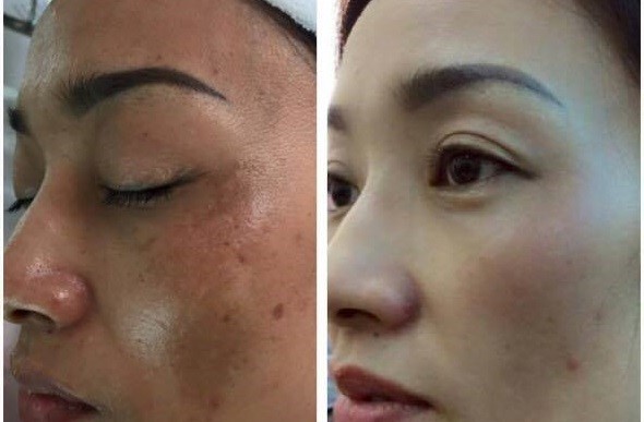 Combo Trị nám Queenie 24 tri nam 3